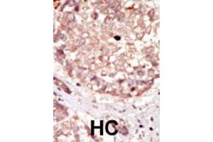 Formalin-fixed and paraffin-embedded human hepatocellular carcinoma tissue reacted with HIPK3 polyclonal antibody  , which was peroxidase-conjugated to the secondary antibody, followed by DAB staining. (HIPK3 Antikörper)