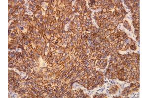 Immunohistochemistry (IHC) image for anti-Receptor tyrosine-protein kinase erbB-2 (ErbB2/Her2) (C-Term) antibody (ABIN870541) (ErbB2/Her2 Antikörper  (C-Term))