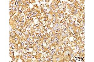 IHC staining of human melanoma (20X) with gp100 antibody (HMB45). (Melanoma gp100 Antikörper)