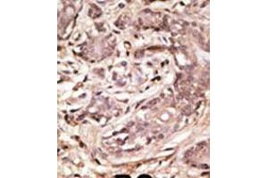 Formalin-fixed and paraffin-embedded human cancer tissue reacted with the primary antibody, which was peroxidase-conjugated to the secondary antibody, followed by AEC staining. (SUMO4 Antikörper  (AA 34-63))