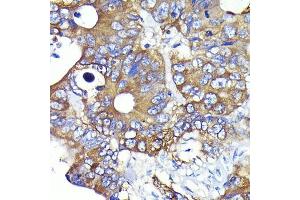 Immunohistochemistry of paraffin-embedded human colon carcinoma using Ezrin Rabbit mAb (ABIN7267077) at dilution of 1:100 (40x lens).