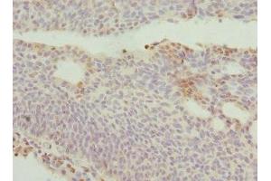 Immunohistochemistry of paraffin-embedded human bladder cancer using ABIN7150145 at dilution of 1:100 (DRAM2 Antikörper  (AA 182-266))