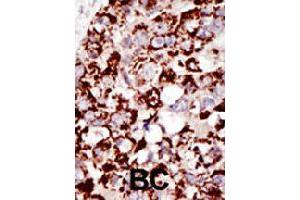 Formalin-fixed and paraffin-embedded human cancer tissue reacted with PIGK polyclonal antibody  , which was peroxidase-conjugated to the secondary antibody, followed by DAB staining . (PIGK Antikörper  (C-Term))
