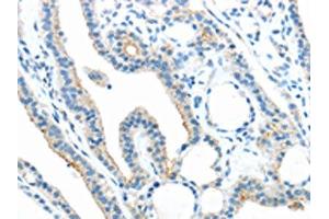 The image on the left is immunohistochemistry of paraffin-embedded Human thyroid cancer tissue using ABIN7189804(ANGPTL5 Antibody) at dilution 1/25, on the right is treated with synthetic peptide. (ANGPTL5 Antikörper)