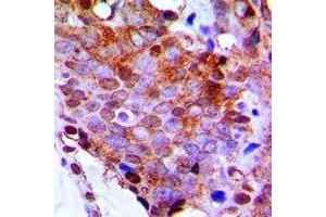 Immunohistochemical analysis of RPL13 staining in human breast cancer formalin fixed paraffin embedded tissue section.