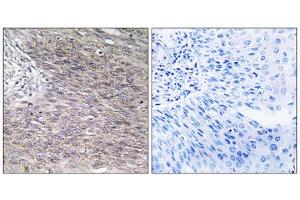 Immunohistochemistry analysis of paraffin-embedded human cervix carcinoma tissue using CHSS2 antibody. (CHPF Antikörper  (C-Term))