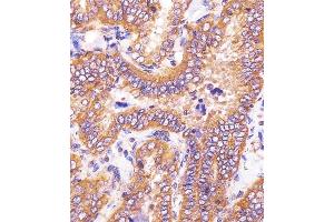 (ABIN6243230 and ABIN6578764) staining HSD17B10 in human thyroid carcinoma sections by Immunohistochemistry (IHC-P - paraformaldehyde-fixed, paraffin-embedded sections).