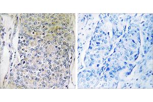 Peptide - +Immunohistochemistry analysis of paraffin-embedded human breast carcinoma tissue using CPXM2 antibody. (CPXM2 Antikörper)