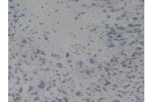 IHC-P analysis of Human Lung Cancer Tissue, with DAB staining.