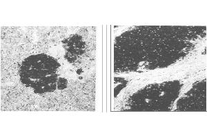 Immunohistochemical staining of normal pancreas tissue (left) and small bowel tumor tissue (center) using NSE antibody (X2070M and X2071M). (Enolase Antikörper)