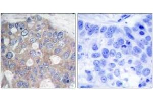 Immunohistochemistry analysis of paraffin-embedded human breast carcinoma tissue, using p70 S6 Kinase (Ab-421) Antibody. (RPS6KB1 Antikörper  (AA 411-460))