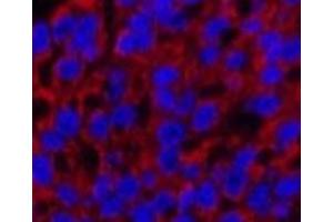 Immunofluorescence analysis of Human liver cancer tissue using Cleaved-CASP3 p12 (D175) Polyclonal Antibody at dilution of 1:200. (Caspase 3 p12 (Cleaved-Asp175) Antikörper)