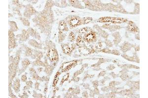 IHC-P Image Immunohistochemical analysis of paraffin-embedded human breast cancer, using Factor XI, antibody at 1:250 dilution. (Factor XI Antikörper)