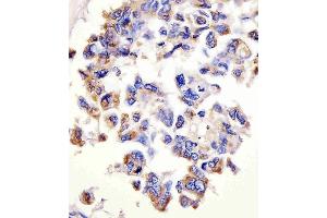 (ABIN1882228 and ABIN2843486) staining CTSD in human lung adenocarcinoma tissue sections by Immunohistochemistry (IHC-P - paraformaldehyde-fixed, paraffin-embedded sections).