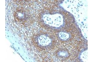 IHC testing of FFPE human cervical squamos cell carcinoma with CD44v4 antibody (clone CD44v4/1219). (CD44v4 Antikörper)