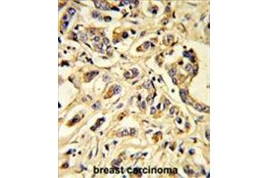 Formalin-fixed and paraffin-embedded human breast carcinoma reacted with VGFR1 Antibody, which was peroxidase-conjugated to the secondary antibody, followed by DAB staining. (FLT1 Antikörper)