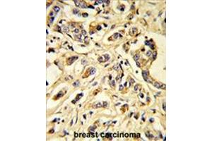 Formalin-fixed and paraffin-embedded human breast carcinoma reacted with VGFR1 Antibody, which was peroxidase-conjugated to the secondary antibody, followed by DAB staining.