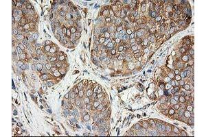 Immunohistochemical staining of paraffin-embedded Adenocarcinoma of Human breast tissue using anti-TUBB4 mouse monoclonal antibody. (TUBB4 Antikörper)