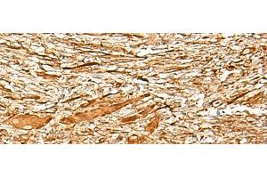 Immunohistochemistry of paraffin-embedded Human liver cancer tissue using ADGRF1 Polyclonal Antibody at dilution of 1:35(x200) (G Protein-Coupled Receptor 110 Antikörper)