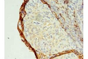 Immunohistochemistry of paraffin-embedded human breast cancer using ABIN7159148 at dilution of 1:100 (MED28 Antikörper  (AA 1-178))