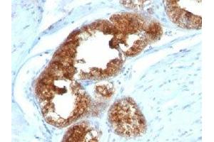 IHC staining of human prostate carcinoma with TAG-72 antibody cocktail (B72. (TAG-72 Antikörper)
