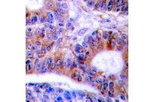 Immunohistochemical analysis of Cytokeratin 20 staining in human colon cancer formalin fixed paraffin embedded tissue section. (KRT20 Antikörper  (C-Term))