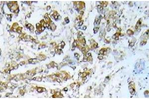 Immunohistochemistry (IHC) analyzes of HSP27 pAb in paraffin-embedded human breast carcinoma tissue. (HSP27 Antikörper)