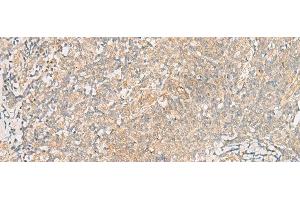 Immunohistochemistry of paraffin-embedded Human tonsil tissue using TRAF6 Polyclonal Antibody at dilution of 1:30(x200) (TRAF6 Antikörper)