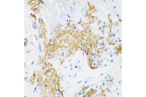 Immunohistochemistry of paraffin-embedded human lung cancer using ELN antibody (ABIN6291688) at dilution of 1:100 (40x lens). (Elastin Antikörper)