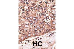 Formalin-fixed and paraffin-embedded human hepatocellular carcinoma tissue reacted with WISP1 polyclonal antibody  , which was peroxidase-conjugated to the secondary antibody, followed by DAB staining. (WISP1 Antikörper  (Internal Region))