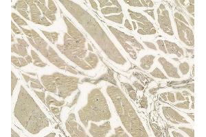 ABIN6259278 and ABIN6273603 at 1/100 staining human tongue carcinoma by IHC-P.