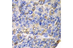 Immunohistochemistry of paraffin-embedded human liver cancer using CES1 antibody (ABIN5970951) at dilution of 1/100 (40x lens). (CES1 Antikörper)