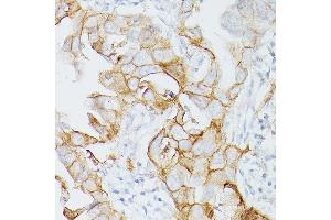 Immunohistochemistry of paraffin-embedded Human lung adenocarcinoma using PD-L1/CD274/CD274 Rabbit mAb (ABIN7266181) at dilution of 1:200 (40x lens). (PD-L1 Antikörper  (Extracellular Domain))