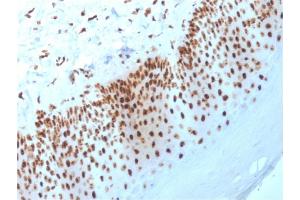 Formalin-fixed, paraffin-embedded human Basal Cell Carcinoma stained with Nucleophosmin Mouse Monoclonal Antibody (NPM1/3398). (NPM1 Antikörper  (AA 185-287))