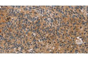 Immunohistochemistry of paraffin-embedded Human esophagus cancer tissue using TAC1 Polyclonal Antibody at dilution 1:25 (TAC1 Antikörper)