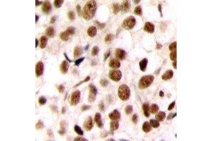 Immunohistochemical analysis of C/EBP zeta staining in human breast cancer formalin fixed paraffin embedded tissue section. (DDIT3 Antikörper  (N-Term))