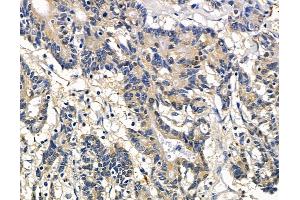 ABIN7097056 and ABIN7101123 at 1/100 staining human colorectal cancer and adjacent non-tumor tissue by IHC-P. (NHLRC2 Antikörper)