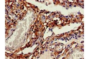 Immunohistochemistry of paraffin-embedded human lung cancer using ABIN7146203 at dilution of 1:100 (OB Cadherin Antikörper  (AA 637-796))