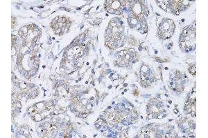 Immunohistochemistry of paraffin-embedded human breast cancer using BRCA1 antibody. (BRCA1 Antikörper  (AA 120-220))