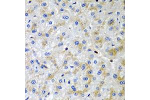 Immunohistochemistry of paraffin-embedded human liver injury using SRGN antibody (ABIN5974179) at dilution of 1/200 (40x lens). (SRGN Antikörper)