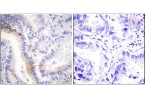 Immunohistochemistry analysis of paraffin-embedded human lung carcinoma tissue, using urocortin antibody. (Urocortin Antikörper  (C-Term))