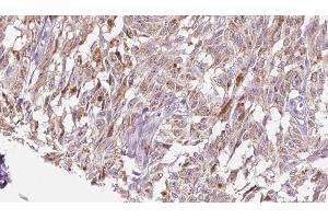 ABIN6276527 at 1/100 staining Human Melanoma tissue by IHC-P. (CRH Antikörper  (N-Term))