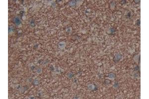 Detection of AQP4 in Human Glioma Tissue using Polyclonal Antibody to Aquaporin 4 (AQP4) (Aquaporin 4 Antikörper  (AA 178-317))