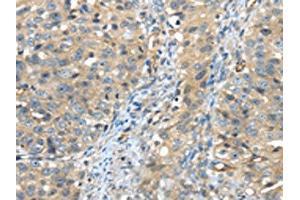 The image on the left is immunohistochemistry of paraffin-embedded Human breast cancer tissue using ABIN7191125(ISM2 Antibody) at dilution 1/45, on the right is treated with synthetic peptide. (Isthmin 2 Antikörper)