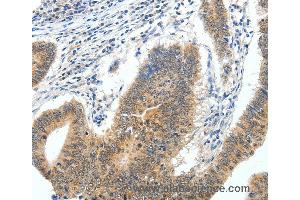 Immunohistochemistry of Human gastric cancer using ECE2 Polyclonal Antibody at dilution of 1:40 (ECE2 Antikörper)