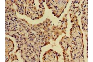 Immunohistochemistry of paraffin-embedded human lung cancer using ABIN7143798 at dilution of 1:100 (A2ML1 Antikörper  (AA 625-751))
