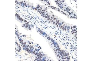 Immunohistochemistry of paraffin-embedded human colon carcinoma using N Rabbit mAb (ABIN7268774) at dilution of 1:100 (40x lens). (NAT10 Antikörper)
