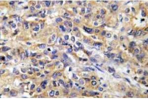 Immunohistochemistry (IHC) analyzes of COX17 antibody in paraffin-embedded human liver carcinoma tissue. (COX17 Antikörper)