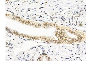 ABIN7094862 and ABIN7098913 at 1/100 staining Human kidney cancer by IHC-P.