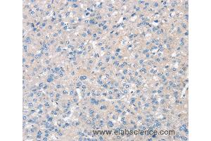 Immunohistochemistry of Human liver cancer using SNX3 Polyclonal Antibody at dilution of 1:30 (Sorting Nexin 3 Antikörper)